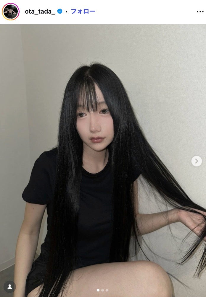 「月曜から夜ふかし」多田さん「口周り顎周りの拘縮と腫れはMAX」“開口指1.5本くらい”整形手術ダウンタイム12日目 回復状況報告に「顔がスッキリ」「アザがなくなってる」の声