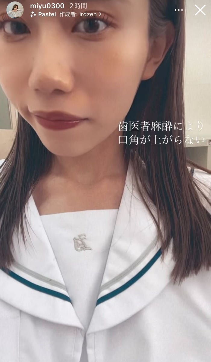 片方だけ口角が上がらないみゆ/みゆ公式Instagramストーリーズより
