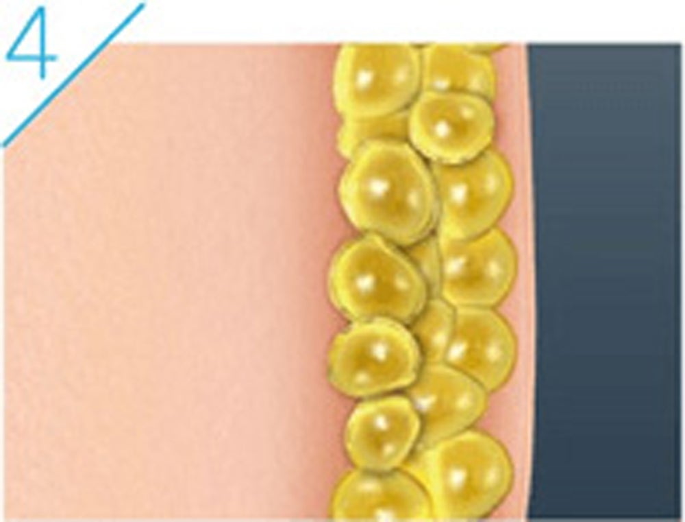 排出された脂肪の分のふくらみが減ります。脂肪細胞を小さくするのではなく、脂肪細胞の数自体が減るため、リバウンドしにくいのが特徴です。（提供画像）