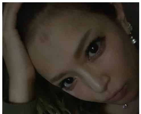 浜崎あゆみ、顔に火傷 心配の声相次ぐ