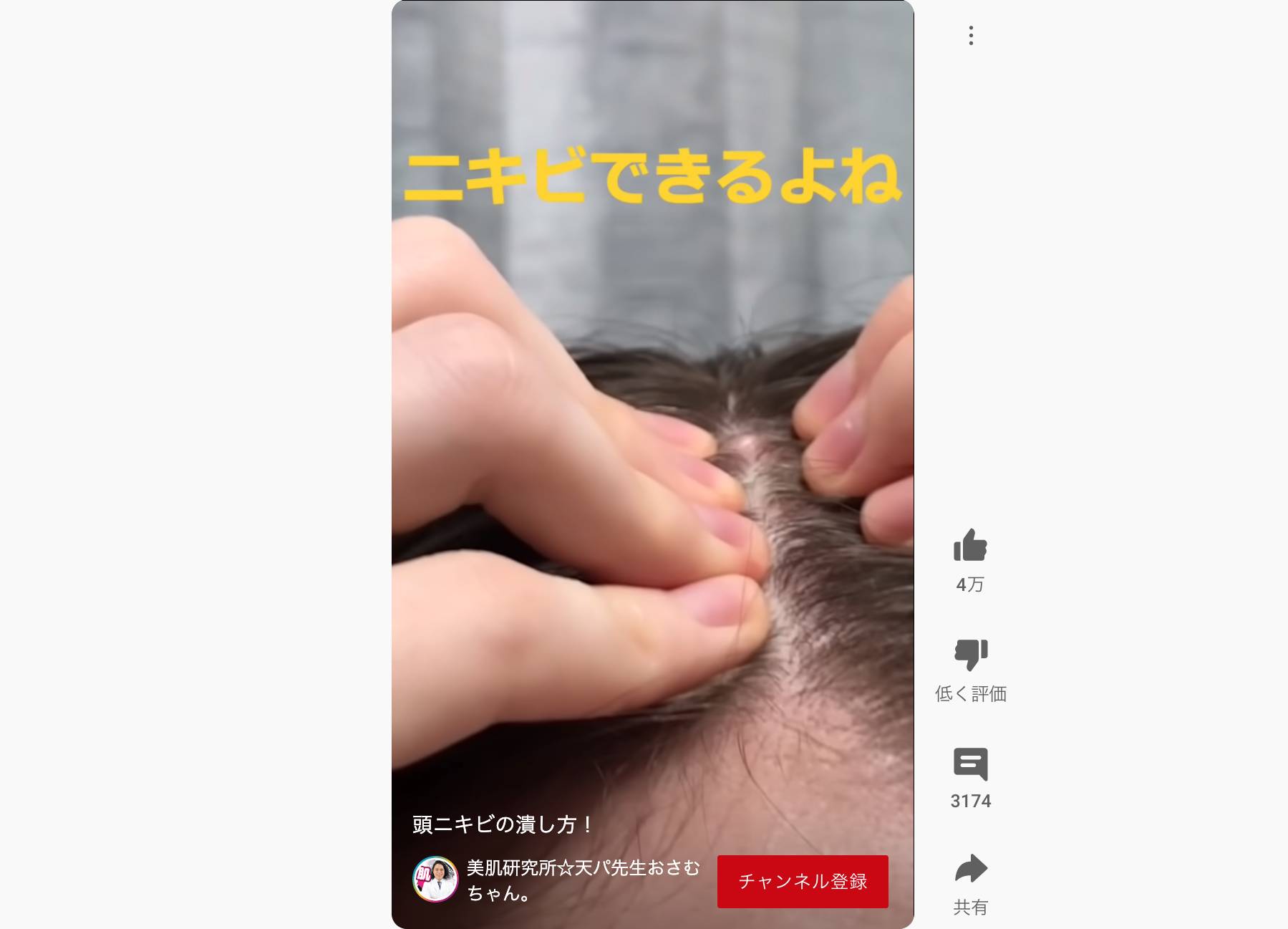 頭皮のニキビを潰す動画が300万再生 脳みそ出てきてもうてる 閲覧注意が遅すぎる モデルプレス