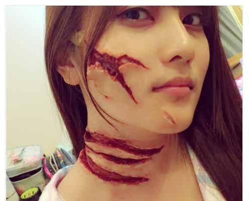 AKB48入山杏奈、痛々しい姿に「びっくりした」の声