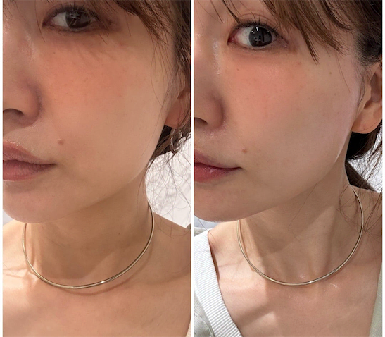 あいのり・桃、糸リフト施術後の変化に驚き＆ビフォアフ写真も公開「違いが凄い！！」