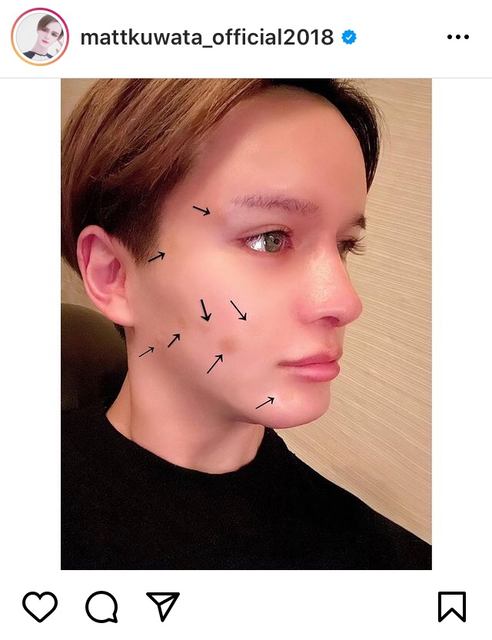 Matt ホクロ除去を報告 術後セルフィーに 美しすぎます すっぴん神様 と反響 モデルプレス Matt ホクロ除去を報告 術後セルフィーに 美しすぎます すっぴん神様 と反響 モデルプレス