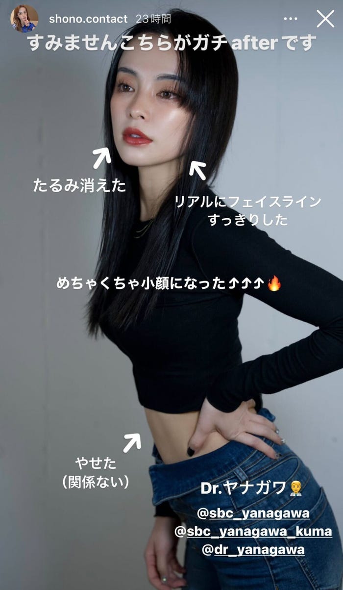 糸リフト施術後ショット/SHONO公式Instagramストーリーズより