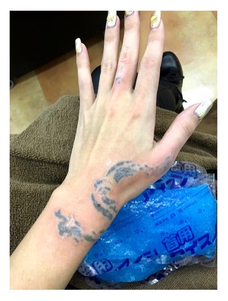 今回の除去直後/みぽちオフィシャルブログ(Ameba)より