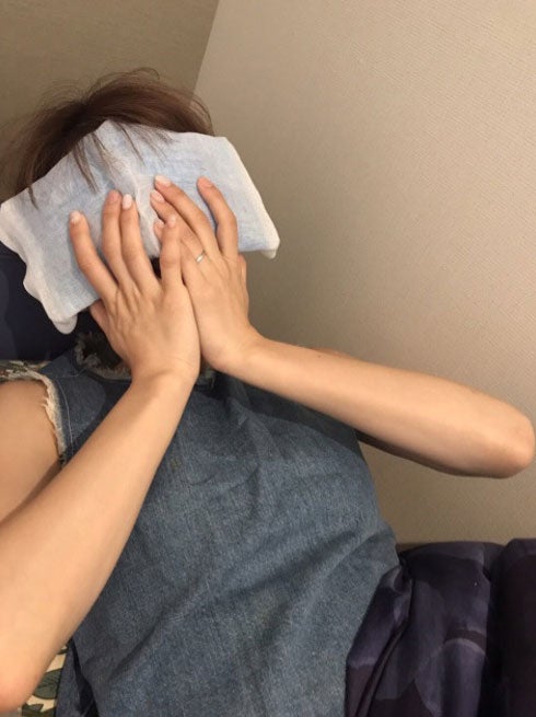 二重整形手術後、アイシング中の桃／桃オフィシャルブログ（Ameba）より