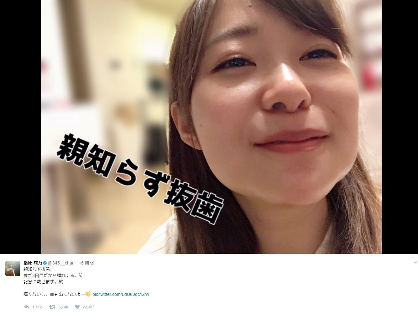 親知らず4本抜歯の指原莉乃 顔写真を公開 腫れすぎて笑っちゃう モデルプレス