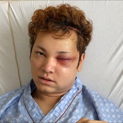 顔を失ったイケメン俳優 間瀬翔太の今は 7時間の手術乗り越えて モデルプレス