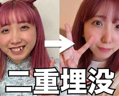 整形告白のパーパーあいなぷぅ、ダウンタイム中の様子説明 ビフォーアフターも公開