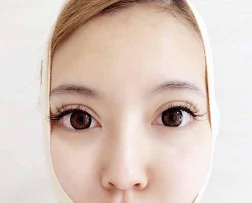 脂肪吸引施術の双子モデル・吉川ちか、手術費用を告白「高すぎてびっくり」