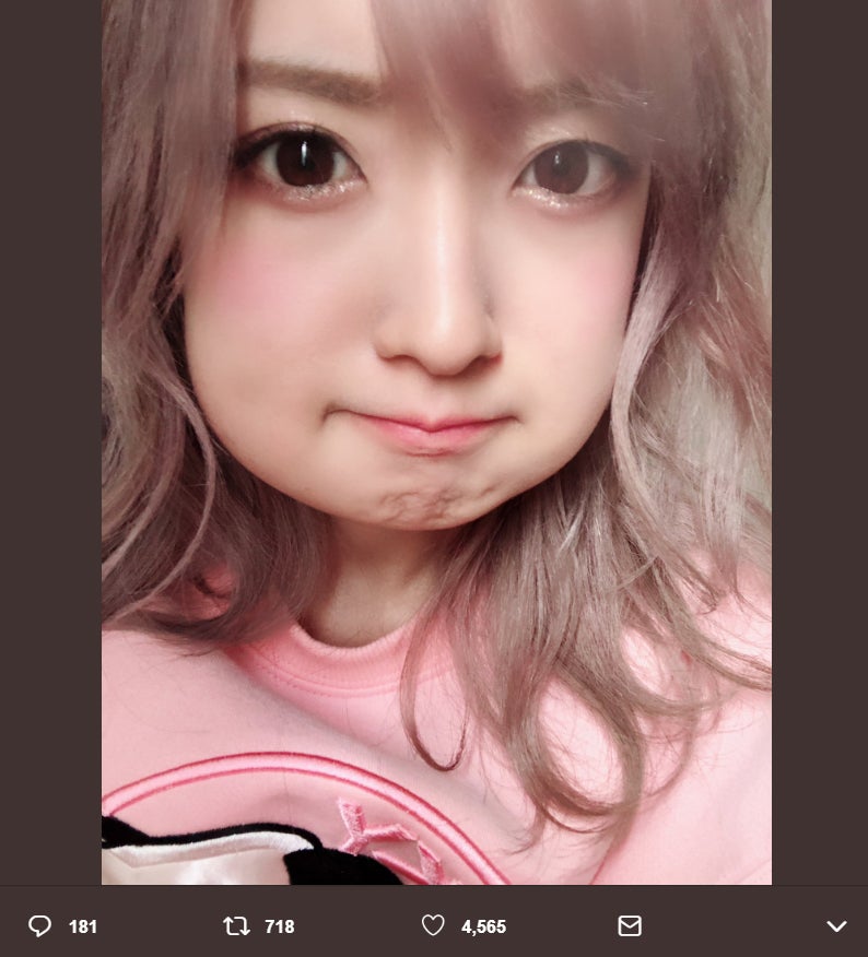 須藤凜々花、親知らず2本抜歯 頬が腫れ上がった自撮りに「加工かと思った」の声