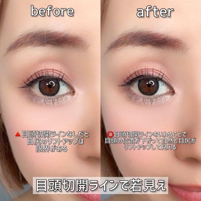 目頭切開ラインで若見え　ビフォー　アフター