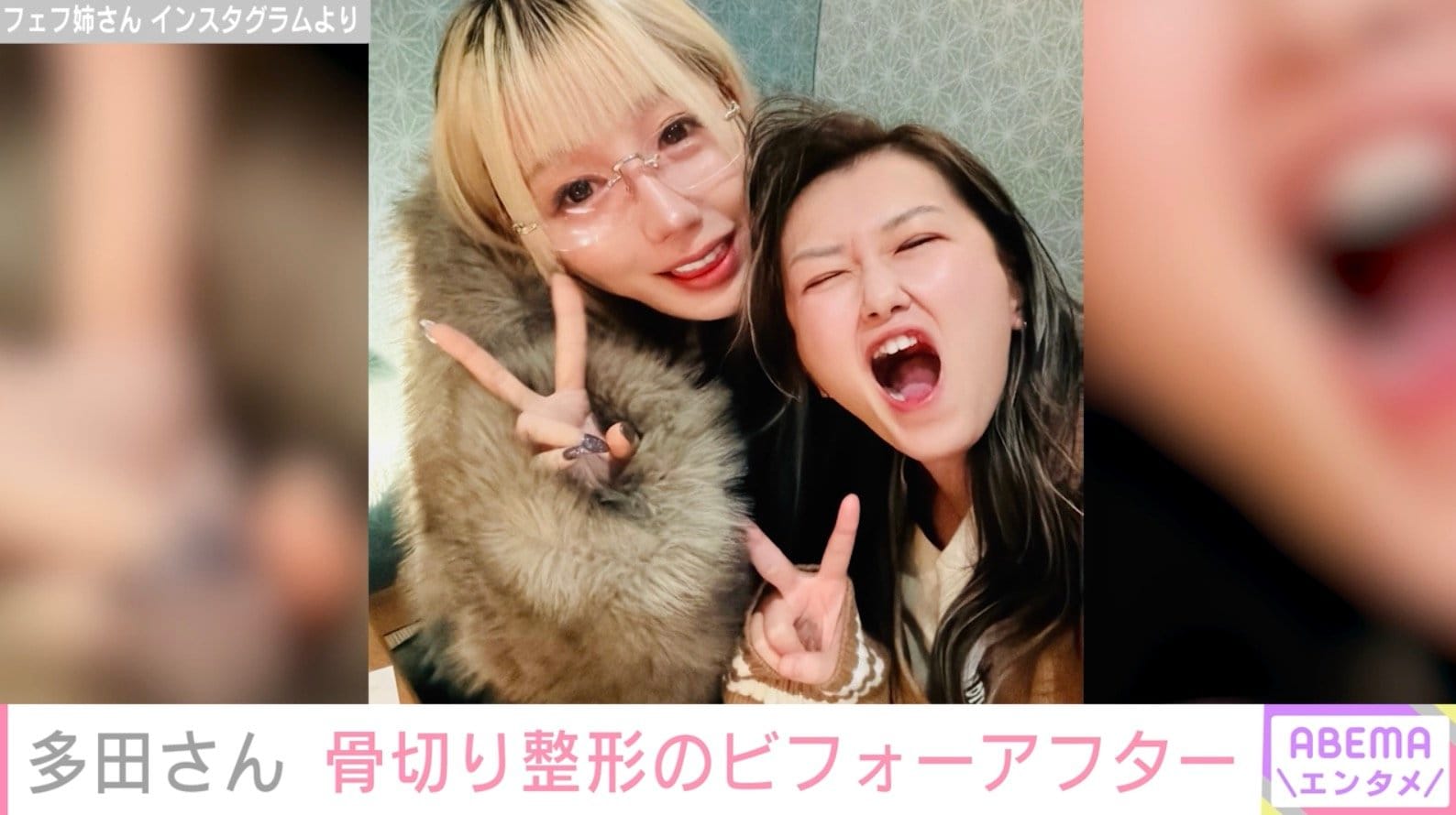 『月曜から夜ふかし』フェフ姉さんの友人・多田さん、両あご&輪郭骨切り整形のビフォーアフターを公開「顔小さくなった」