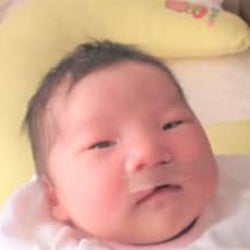 口唇口蓋裂って何?!治るの? 先天異常を持った娘の症状と治療【前編】