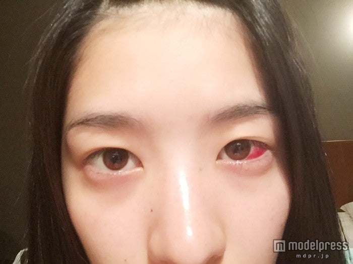 画像3/13) 斜視手術後“初の撮影” 再スタート直前の仮面女子