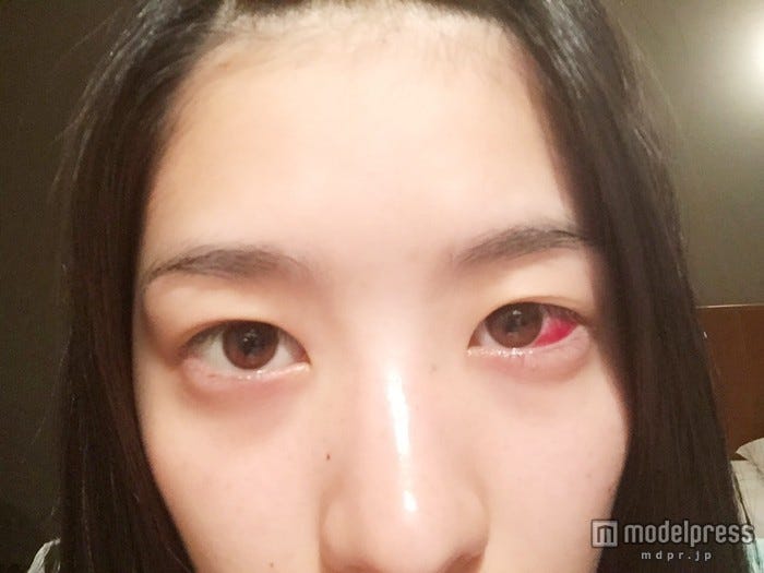 手術直後の目は血でにじんでいた