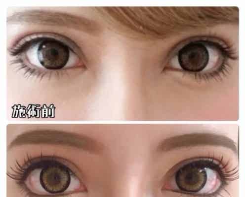 整形公表双子モデルの妹・吉川ちか、“壮絶手術”経過を動画で解説