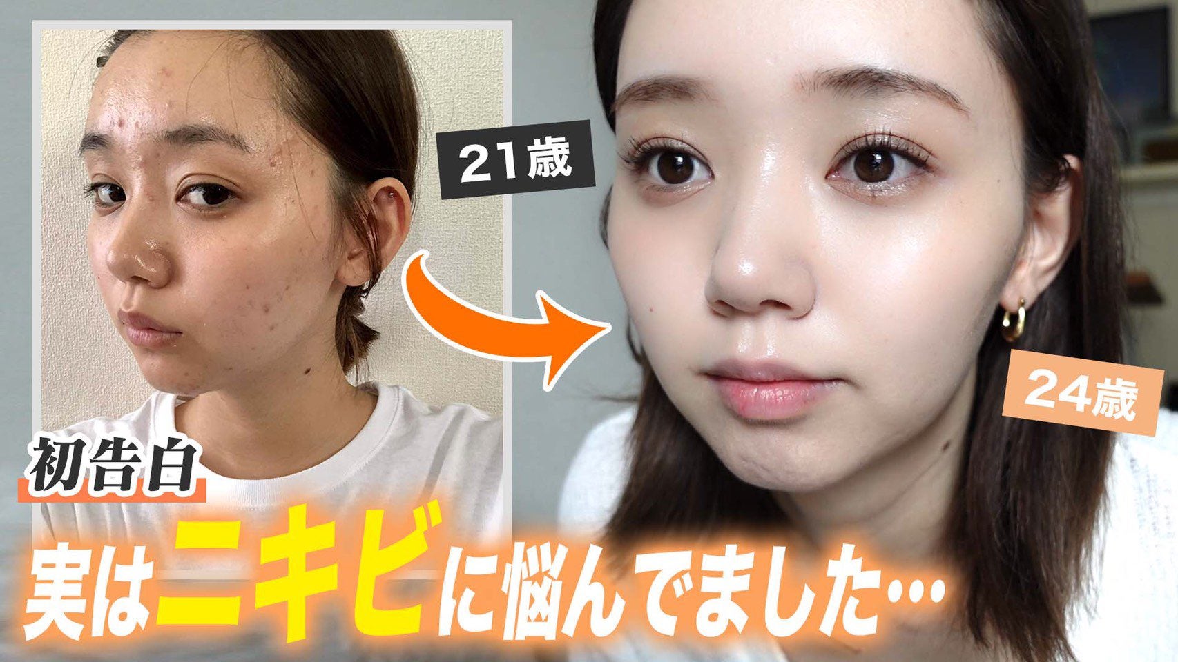 江野沢愛美、ニキビ肌に悩んだ過去初告白 当時と現在の比較写真も公開「悩んでるみんなの背中押せたら嬉しい」
