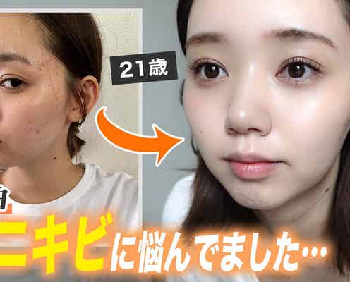 江野沢愛美、ニキビ肌に悩んだ過去初告白 当時と現在の比較写真も公開「悩んでるみんなの背中押せたら嬉しい」