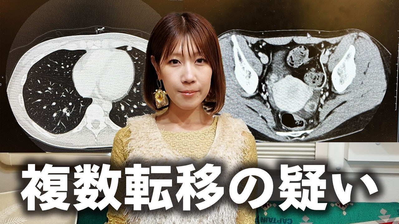 膵臓がん公表のYouTuber、複数転移の疑いで入院することに