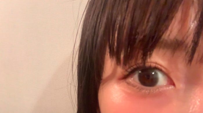 埋没手術から1ヶ月経過した目元/桃オフィシャルブログ(Ameba)より