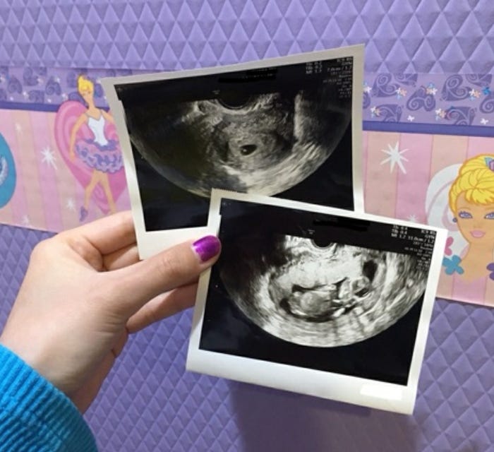 ぺこ第1子妊娠 エコー写真公開 性別は モデルプレス