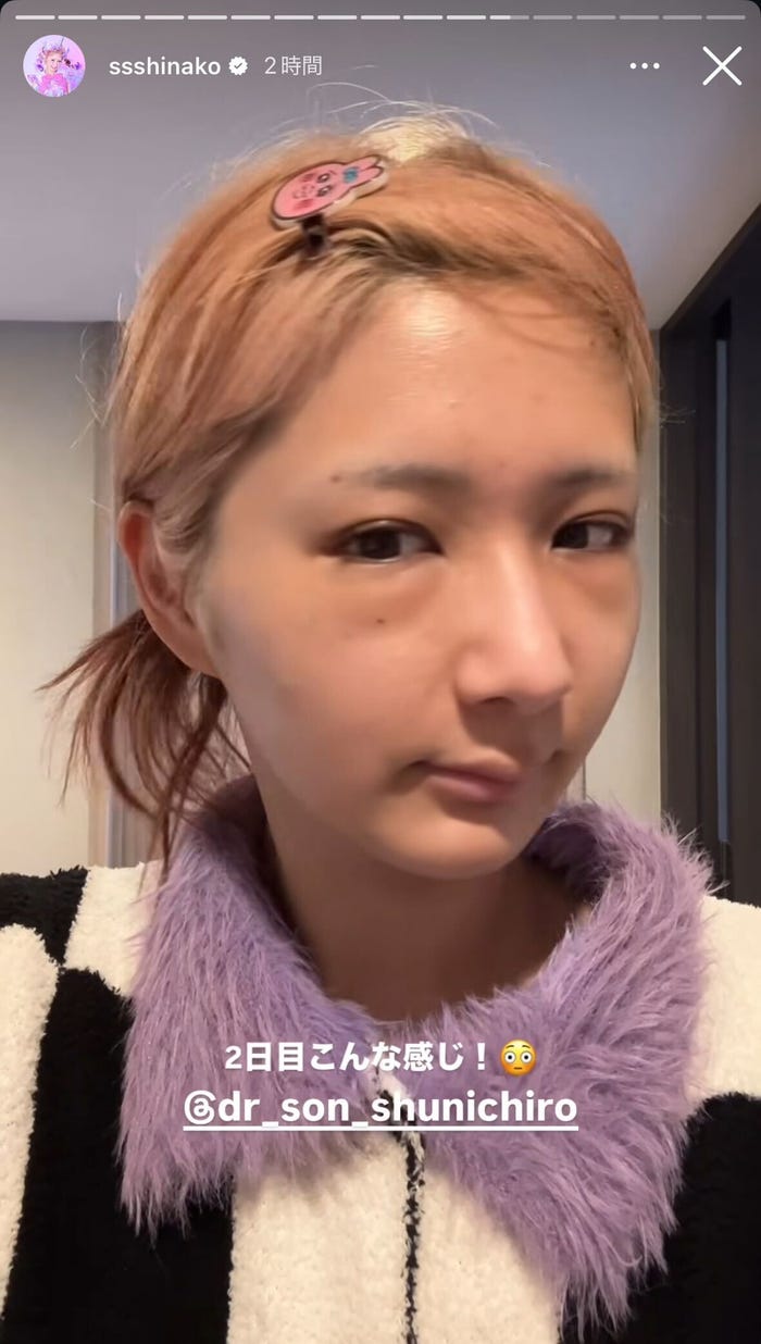 術後2日目の姿/しなこInstagramストーリーズより