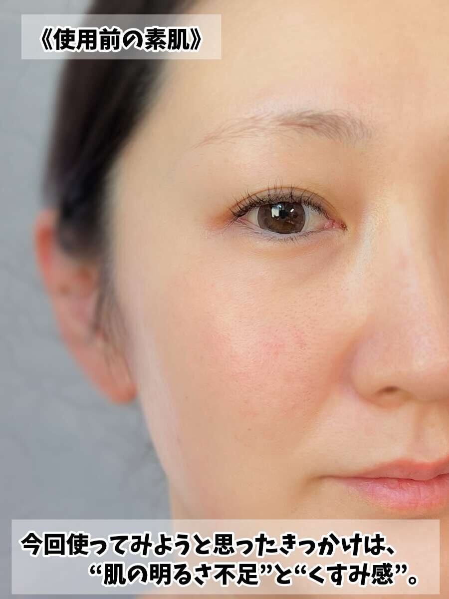 クオリティファースト ダーマレーザー 使用前の素肌、明るさ不足とくすみが気になる40代の肌