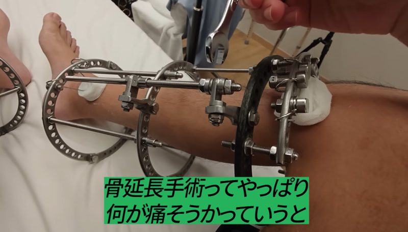 1000万円かけて身長7cm増やしたYouTuberイワサキの壮絶記録