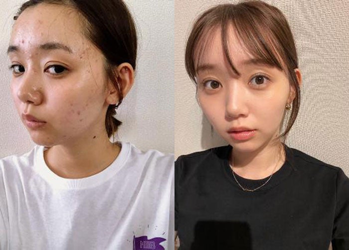 江野沢愛美がニキビに悩んだ過去を初告白 肌荒れ写真公開にも反響 モデルプレス