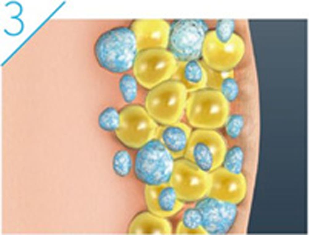 破壊された脂肪細胞は機能しなくなり、2〜4ヶ月程かけて、自然に体外に排出されます。(提供画像)