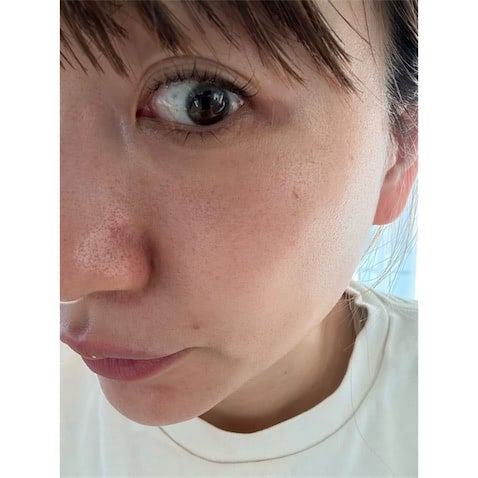 あいのり・桃、美容医療後"ダウンタイム5日目"のドアップショット「顔が…ザラザラしています…！」