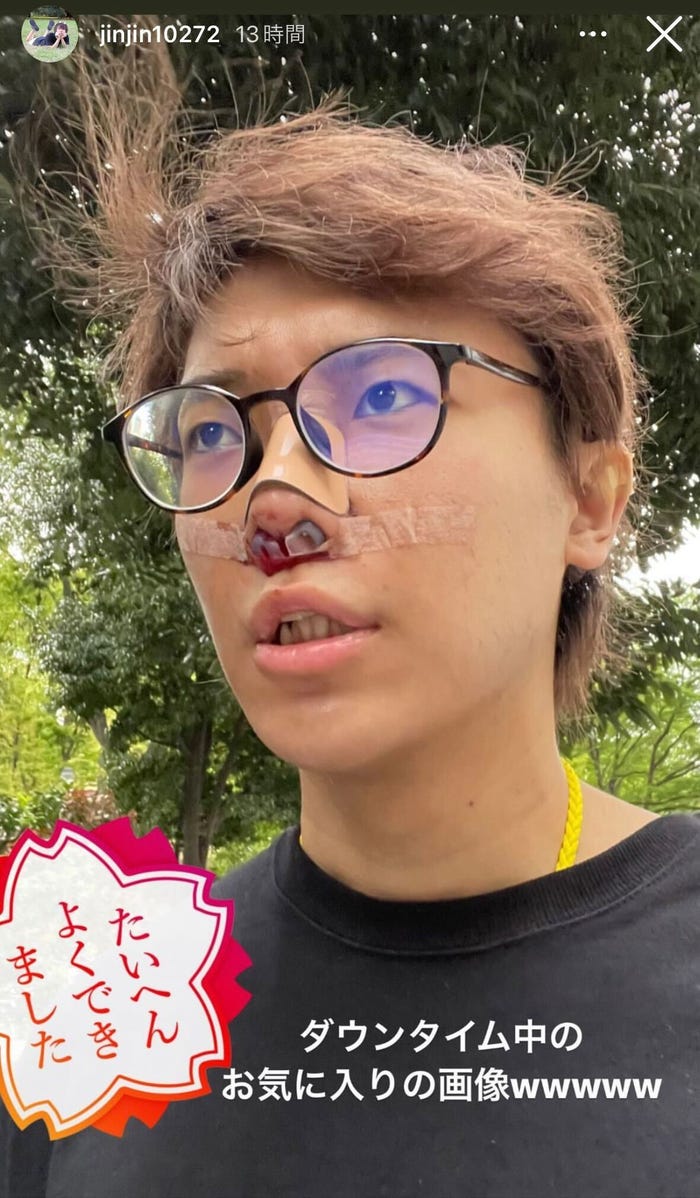 ダウンタイム中の自撮りショット/☆イニ☆公式Instagramストーリーズより