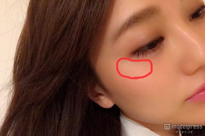 頬骨にも