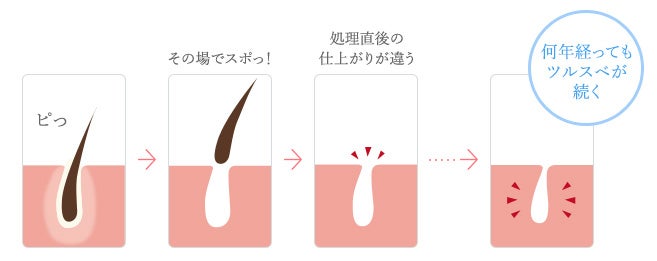 美容電気脱毛の仕組み＜イメージ＞