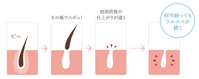 美容電気脱毛の仕組み<イメージ>