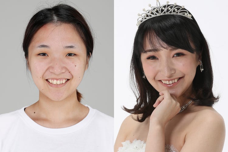 整形ビフォーアフター ダウンタイムの苦労も明かす 太田佑佳さん 外見のせいで卑屈になってしまう自分が嫌だった モデルプレス 整形ビフォーアフター ダウンタイムの苦労も明かす 太田佑佳さん 外見のせいで卑屈になってしまう自分が嫌だった モデルプレス