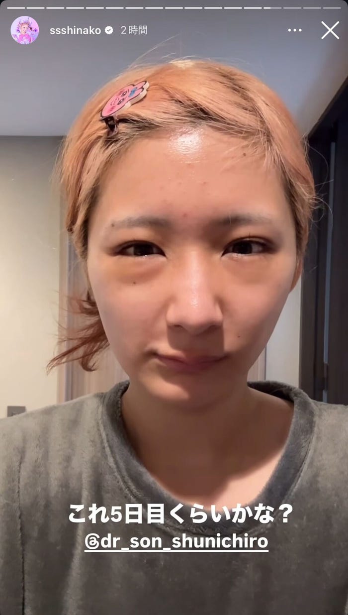 術後5日目の姿/しなこInstagramストーリーズより