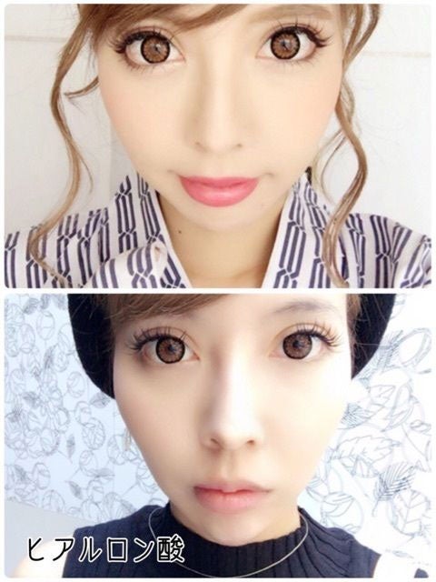 ヒアルロン酸注入前後の写真／吉川ちかオフィシャルブログ（CROOZ）より