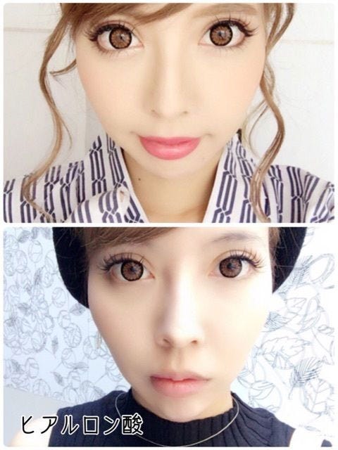 ヒアルロン酸注入前後の写真/吉川ちかオフィシャルブログ(CROOZ)より