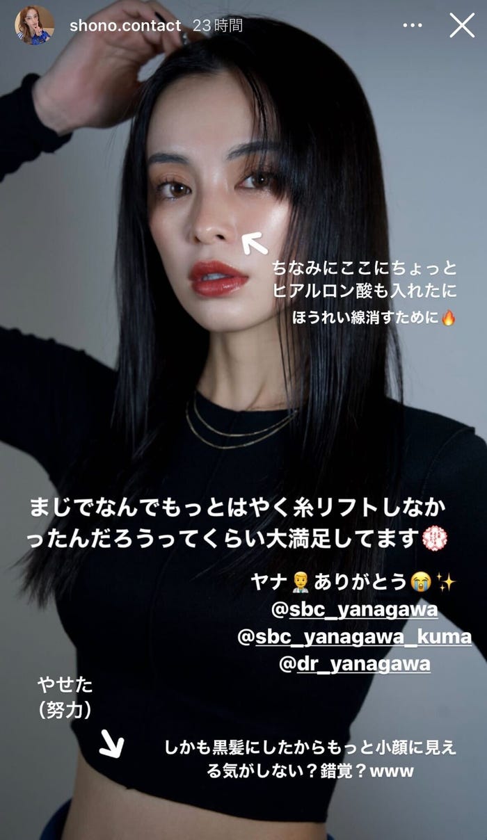 糸リフト施術後ショット/SHONO公式Instagramストーリーズより