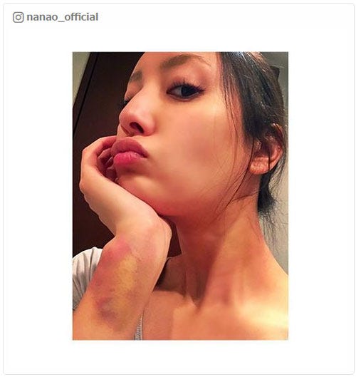 手首の負傷を公開した菜々緒/菜々緒Instagramより