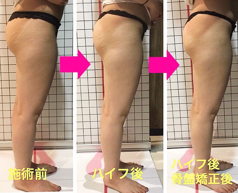 すっきりスリムな美尻へ