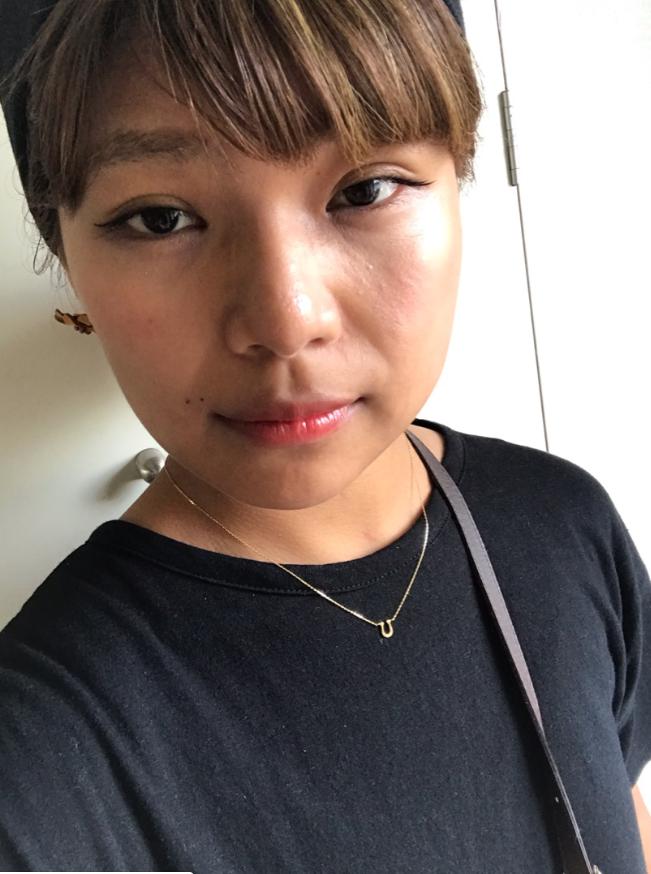 クロ、整形3日目/オフィシャルブログ(Ameba)より