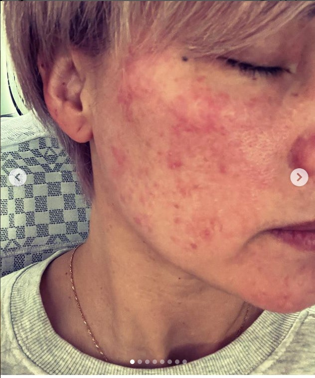 梅宮アンナ、“マツエク接着剤”でのアレルギー症状明かす