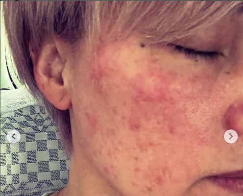 梅宮アンナ、“マツエク接着剤”でのアレルギー症状明かす