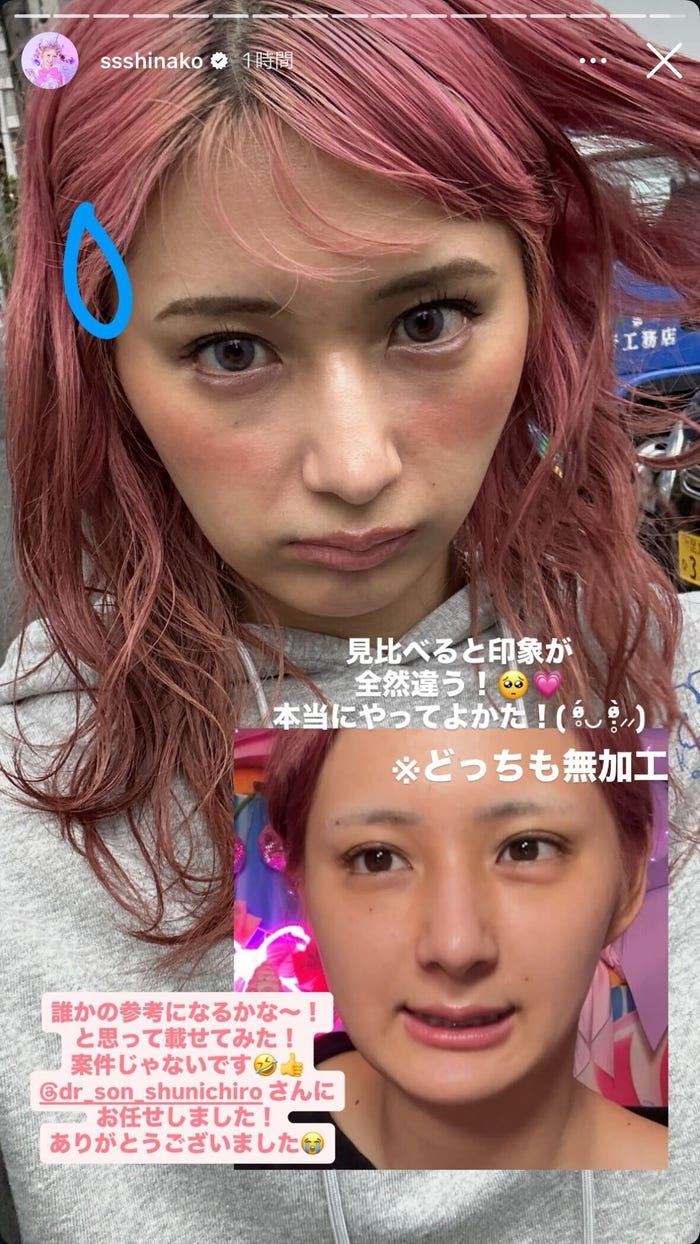 ビフォーアフター/しなこInstagramストーリーズより