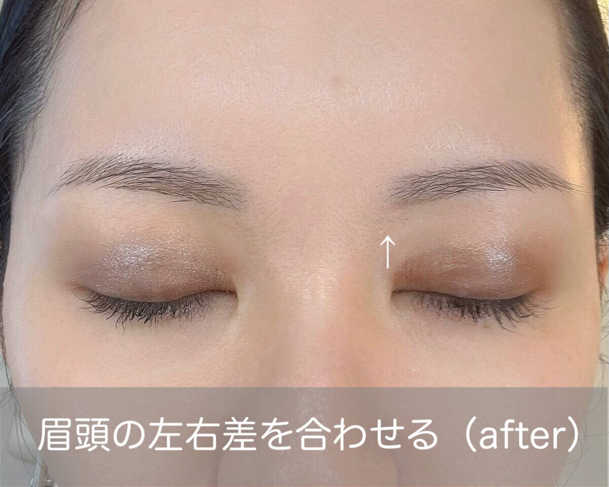 眉頭の左右差を確認　after