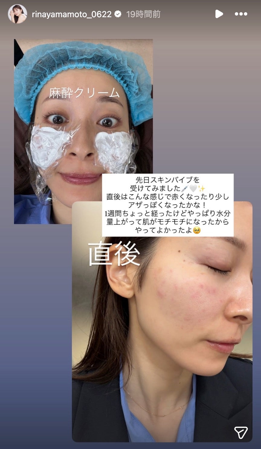 山本里菜アナ公式Instagramストーリーズより